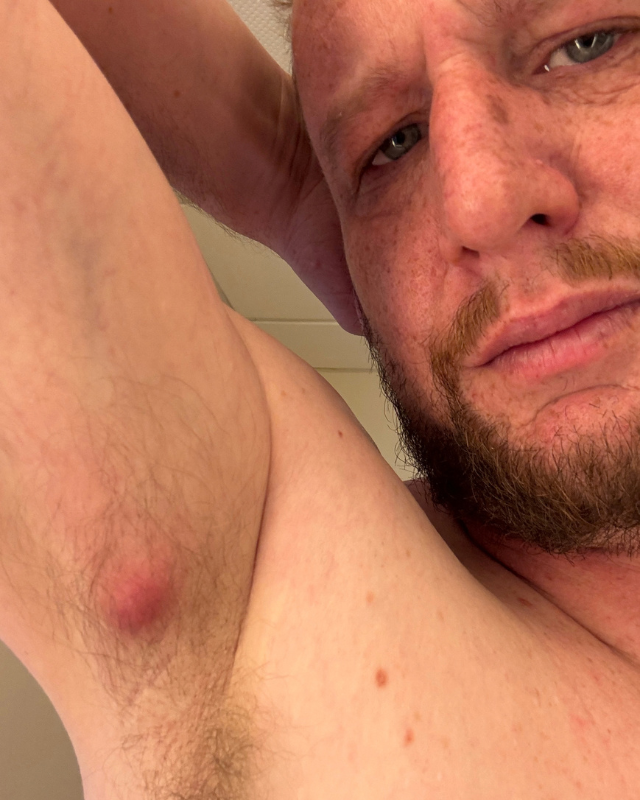 Stage 1 HS — inflamed lump under the arm