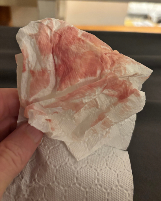 Tissue soaked with fluid — the reality of HS leaking