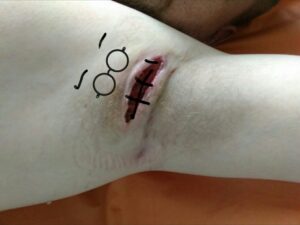 A collection of images showing the reality of severe, Stage 3 HS, including graphic surgical wounds, stitches, and active flare-ups.