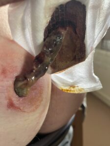 A collection of images showing the reality of severe, Stage 3 HS, including graphic surgical wounds, stitches, and active flare-ups.