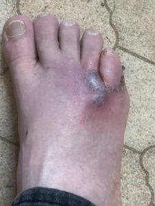 A collection of images showing the reality of severe, Stage 3 HS, including graphic surgical wounds, stitches, and active flare-ups.