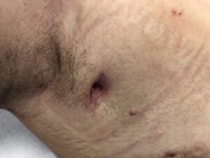 A collection of graphic images showing the reality of Kerrie's severe Stage 3 HS, including scarring and active lesions.