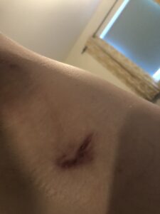 A collection of graphic images showing the reality of Kerrie's severe Stage 3 HS, including scarring and active lesions.