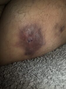 A collection of graphic images showing the reality of Kerrie's severe Stage 3 HS, including scarring and active lesions.