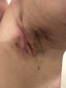 A collection of graphic images showing the reality of Kerrie's severe Stage 3 HS, including scarring and active lesions.