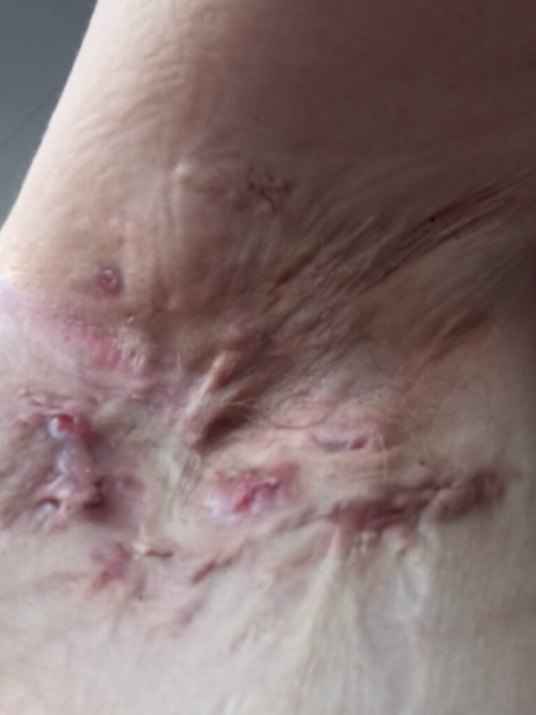 Sammi's Story: "It's Okay to Ask for Help" Significant scarring in the armpit caused by years of recurring Hidradenitis Suppurativa.