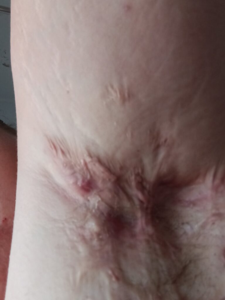Sammi's Story: "It's Okay to Ask for Help" Significant scarring in the armpit caused by years of recurring Hidradenitis Suppurativa.