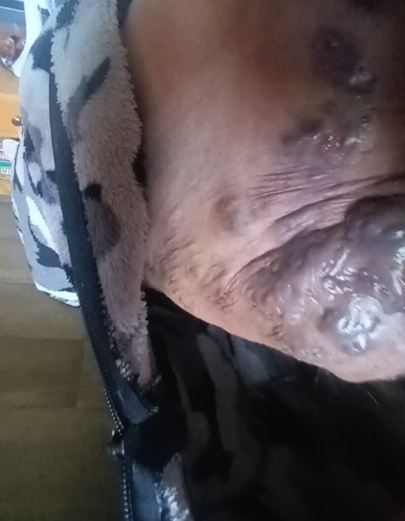 Sammi's Story: "It's Okay to Ask for Help" A large, severe, and inflamed Stage 3 Hidradenitis Suppurativa flare-up.