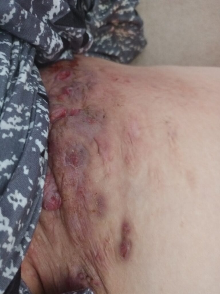 Sammi's Story: "It's Okay to Ask for Help" The reality of long-term Stage 3 HS: extensive scarring and active lesions in the underarm area.