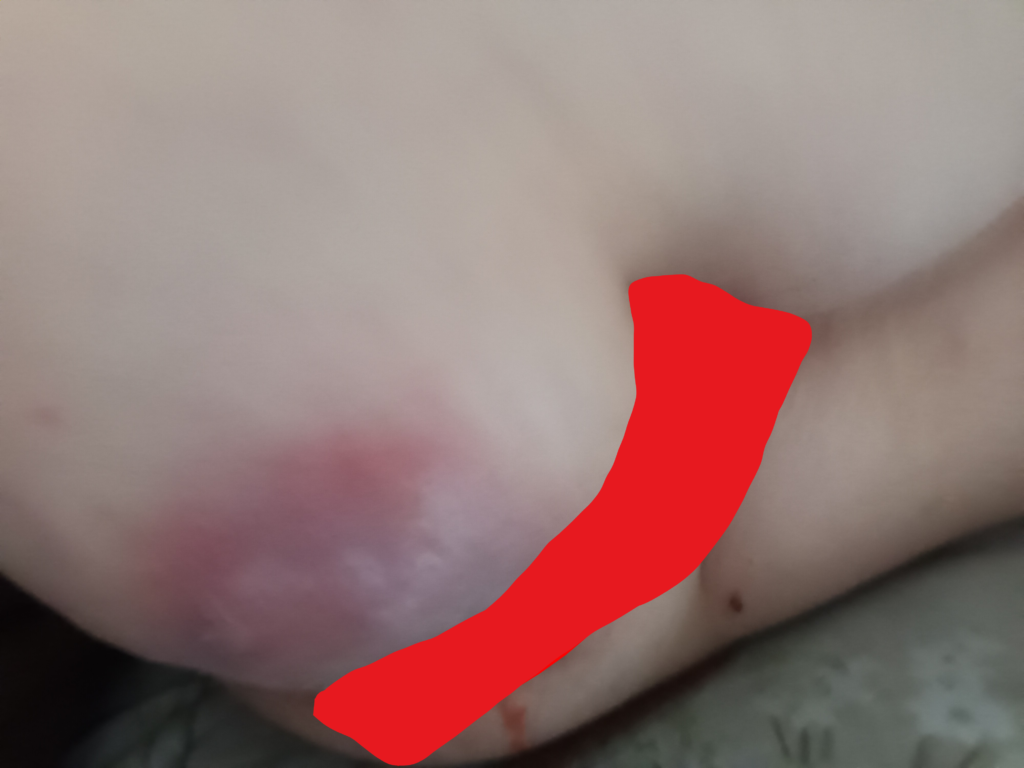 Sammi's Story: "It's Okay to Ask for Help" A large, severe, and inflamed Stage 3 Hidradenitis Suppurativa flare-up.