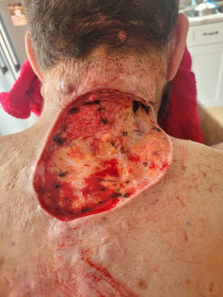 Taylor's Story: Turning Pain Into Purpose A large, graphic wide-excision surgical wound on the back of the neck and upper back for treatment of severe HS.