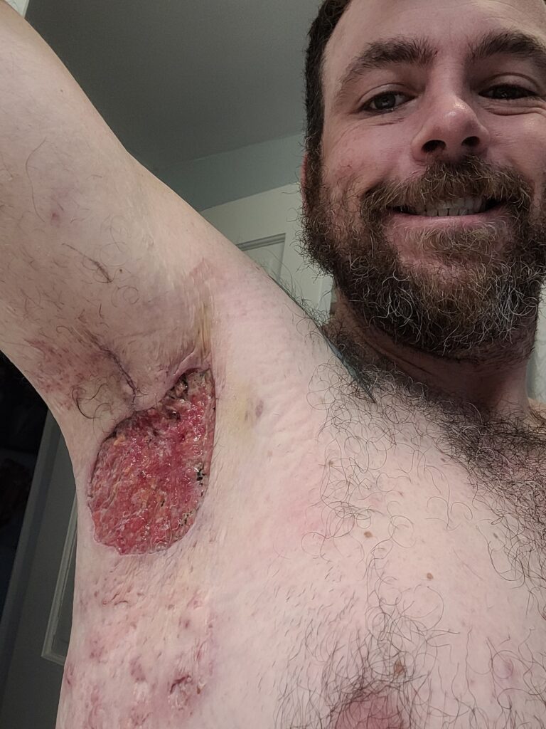 Taylor's Story: Turning Pain Into Purpose A man smiling while showing a large, open de-roofing wound in his armpit from severe HS.