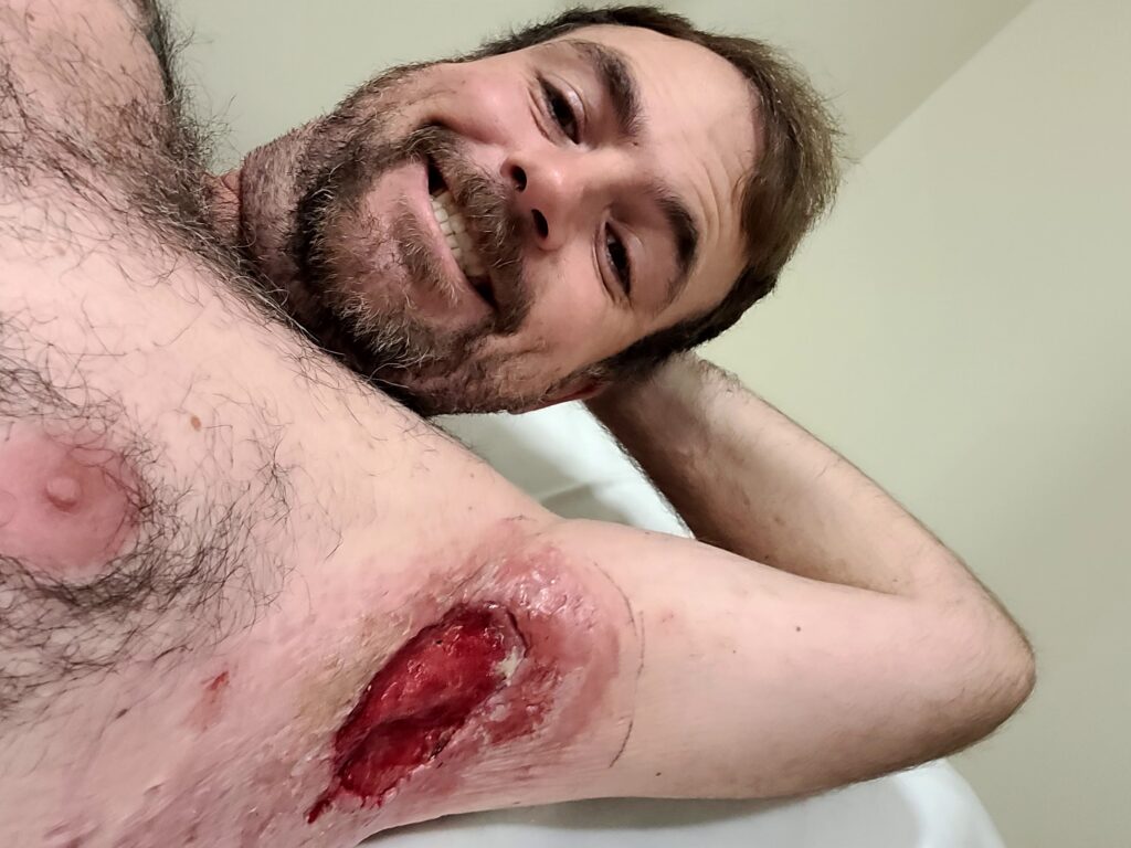 Taylor's Story: Turning Pain Into Purpose A man smiling while showing a large, open de-roofing wound in his armpit from severe HS.