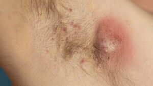 Close-up clinical view of early-stage Hidradenitis Suppurativa inflammation on skin.