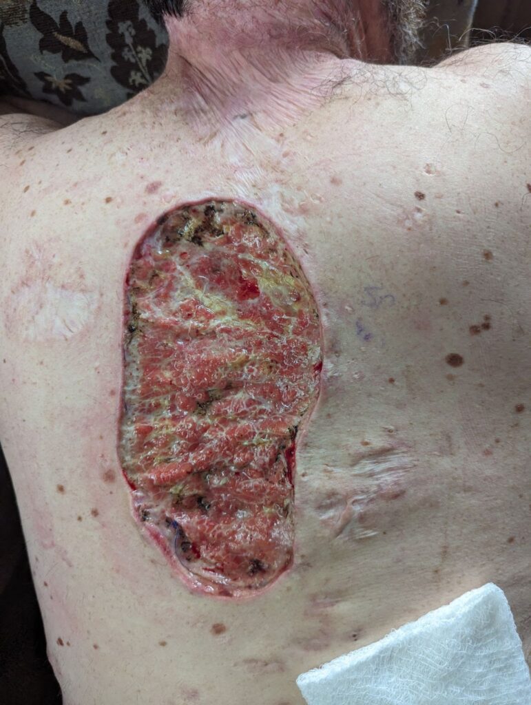 Taylor's Story: Turning Pain Into Purpose A large, graphic wide-excision surgical wound on the back for treatment of severe HS.