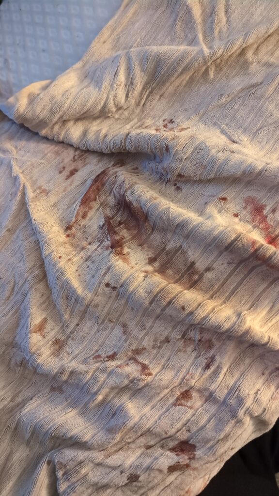 The reality of living with HS: a towel stained with blood and drainage from wounds.
