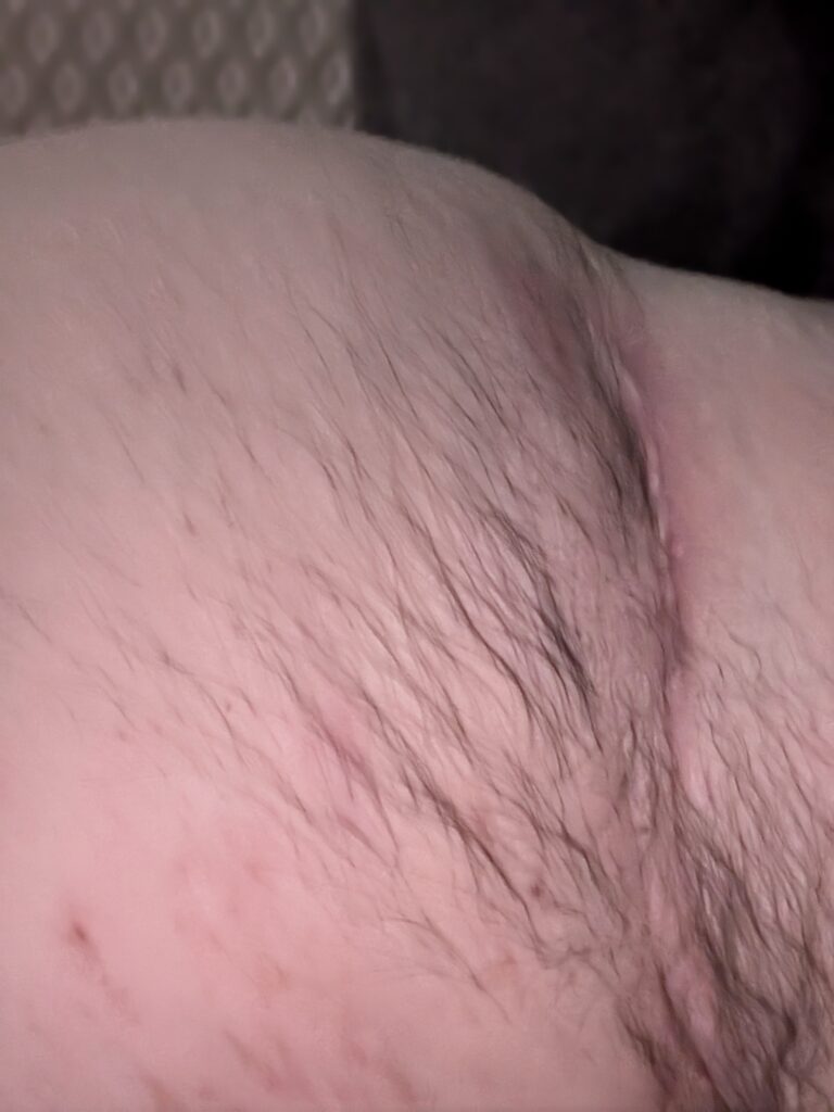 A healed scar in the groin area from previous Hidradenitis Suppurativa flare-ups.