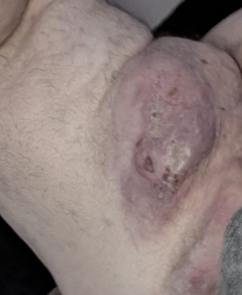 The reality of severe Stage 3 HS: a large, inflamed abscess on the body.