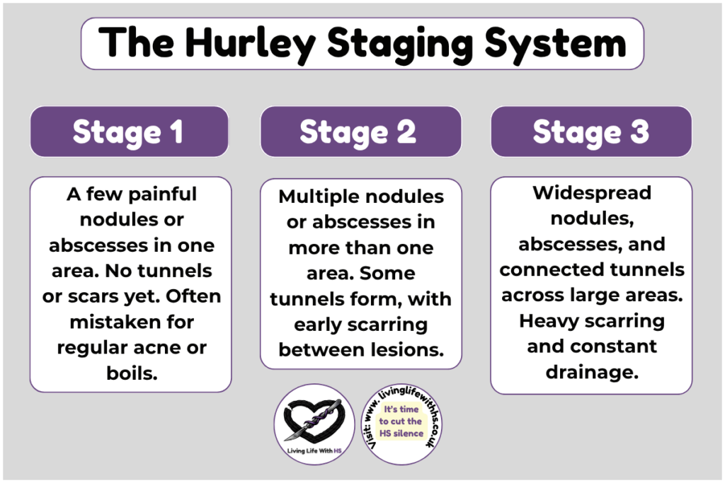 Infographic explaining the three stages of Hidradenitis Suppurativa severity: Hurley Stage 1, Stage 2, and Stage 3