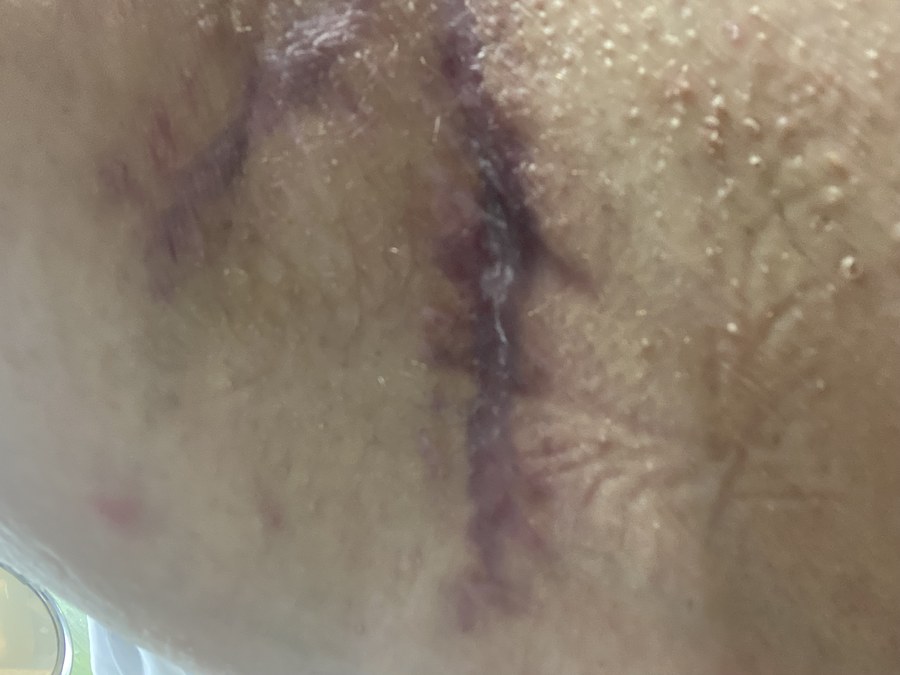 Alana's Story: Stage 2 HS Warrior from Aberdeen Close-up of scarring and affected skin from HS.