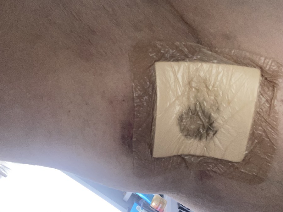 Alana's Story: Stage 2 HS Warrior from Aberdeen HS-affected skin beneath a dressing.