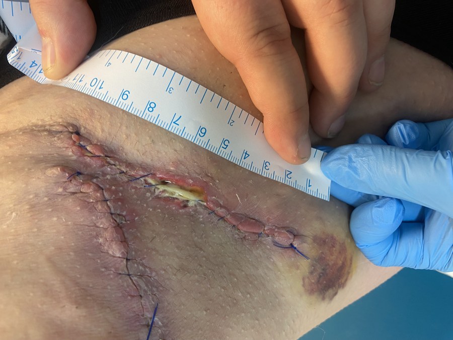 Alana's Story: Stage 2 HS Warrior from Aberdeen HS wound in a skin fold being measured.