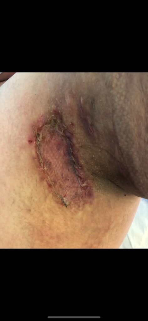Alana's Story: Stage 2 HS Warrior from Aberdeen Close-up of healing HS-affected skin.